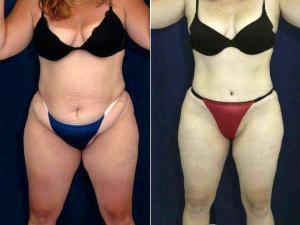 Abdominoplasty And Liposuction To Flanks With Dr. Ricardo L. Rodriguez, MD, Baltimore Plastic Surgeon