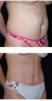 Abdominoplasty And Liposuction With An Umbilical Hernia Repair. With Doctor Brian S. Glatt, MD, FACS, Morristown Plastic Surgeon