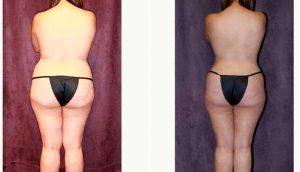 Abdominoplasty, Liposuction, Breast Augmentation, Breast Lift By Dr Paul Fortes, MD, Houston Plastic Surgeon