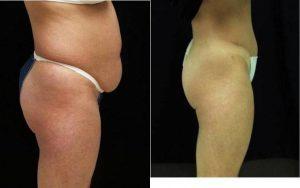 Abdominoplasty, Liposuction By Doctor E. Ronald Finger, MD, Savannah Plastic Surgeon