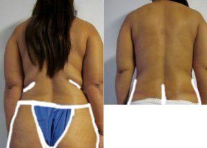 Abdominoplasty Liposuction Mastopexy Beltectomy With Dr Anire Okpaku, MD FACS, Miami Plastic Surgeon