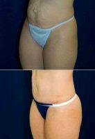 Abdominoplasty, Liposuction To Flanks And Mastopexy (breast Lift). With Doctor Ricardo L. Rodriguez, MD, Baltimore Plastic Surgeon