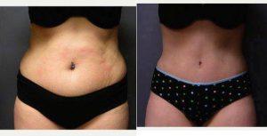 Abdominoplasty (Tummy Tuck) With Ultrasonic Liposuction Waist- 37 Year Old Female, 1 Month Post-op By Dr Scott Barr, MD, Sudbury Plastic Surgeon