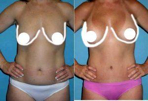 Abdominoplasty With Flank Liposuction, Breast Augmentation By Doctor Sam Jejurikar, MD, Dallas Plastic Surgeon