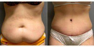 Abdominoplasty With Liposuction - 53 Year Old Female, 2 Months Post-op With Doctor Scott Barr, MD, Sudbury Plastic Surgeon
