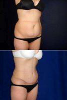 Abdominoplasty With Liposuction Of Flanks With Dr Kelly Gallego, MD, FACS, Yuba City Plastic Surgeon