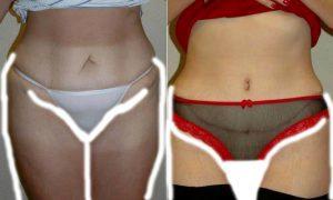 Abdominoplasty With Liposuction Of Hips And Flanks With Doctor Eric T. Emerson, MD, FACS, Charlotte Plastic Surgeon