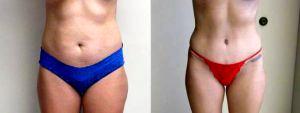 Abdominoplasty With Liposuction Of The Abdomen And Flanks By Dr John A. Ayala, MD, San Antonio Plastic Surgeon