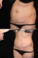 Abdominoplasty With Liposuction Of The Flanks Hips With Doctor Jonathan D. Kramer, MD, Meridian Plastic Surgeon