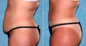 Abdominoplasty With Liposuction To Flanks Hips By Doctor John Zavell, MD, FACS, Toledo Plastic Surgeon