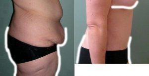 Abdominoplasty With Liposuction To The Hips By Doctor Robert Heck, MD, FACS, Columbus Plastic Surgeon