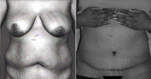 Abdominoplasty With Power-Assisted Liposuction (PAL) Of Flanks By Dr. Manish H. Shah, MD, FACS, Denver Plastic Surgeon