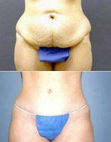 Abdominoplasty With Power-assisted Liposuction By Dr. Richard Kofkoff, MD, FACS, Saint Louis Plastic Surgeon