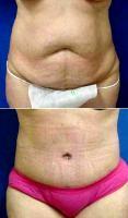 Abdomiplasty (Tummy Tuck) Liposuction Of Abdomen, Flanks And Lateral Chest Areas By Dr. Vincent D. Lepore, MD, San Jose Plastic Surgeon