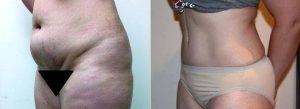 Doctor Alexander Golger, MD, Toronto Plastic Surgeon - Tummy Tuck With Liposuction Of Thighs