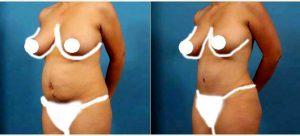 Doctor Brian Coan, MD, FACS, Raleigh-Durham Plastic Surgeon - 37 Year Old Woman Treated With Tummy Tuck And Liposuction