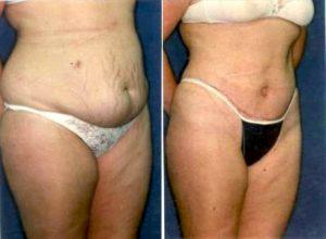 Doctor Charles Virden, MD, Reno Plastic Surgeon - Tummy Tuck For Stretch Marks