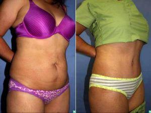 Doctor Christopher T. Maloney Jr., MD, Tucson Plastic Surgeon - 39 Year Old Female Abdominoplasty And Flank Liposuction