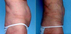 Doctor Dan Mills, MD, Orange County Plastic Surgeon - 61 Year Old Female Treated With Abdominoplasty And Liposuction