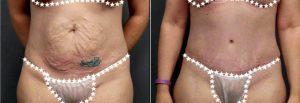 Doctor Dana Goldberg, MD, Jupiter Plastic Surgeon - 36 Year Old Woman Treated With Tummy Tuck For Stretch Marks