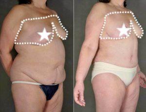 Doctor Daniel Schmid, MD, Morristown Plastic Surgeon - 47 Year Old Woman Treated With Tummy Tuck For Stretch Marks