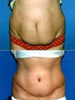 Doctor Dean E. Sorensen, MD, Boise Plastic Surgeon - 55 Year Old Woman With Weakness Of Her Abdominal Musculature