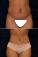 Doctor Douglas L. Gervais, MD, Minneapolis Plastic Surgeon - Abdominoplasty And Liposuction To Hips
