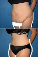 Doctor Erik Miles, MD, FACS, Charlotte Plastic Surgeon - Extended Abdominoplasty With Liposuction Of Flanks