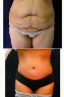 Doctor George Volpe, MD, Newton Plastic Surgeon - Tummy Tuck And Liposuction