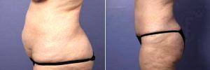 Doctor Grant Stevens, MD, Los Angeles Plastic Surgeon - 50 Yr Old Wanting Tummy Tuck And Liposuction