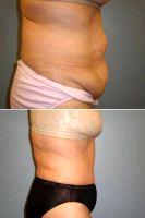 Doctor Heather Rocheford, MD, Minneapolis Plastic Surgeon - 52 Y.O Woman, Who Had A Full Abdominoplasty With Flank Liposuction.