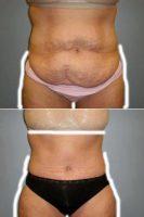 Doctor Heather Rocheford, MD, Minneapolis Plastic Surgeon - 52 Y.O Woman, Who Had A Full Abdominoplasty With Flank Liposuction.