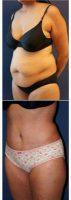 Doctor Joshua D. Zuckerman, MD, FACS, New York Plastic Surgeon - 42 Year Old Woman Treated With Tummy Tuck, Liposuction To Flanks And Inner Thighs