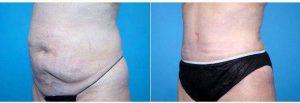 Doctor Landon Pryor, MD, FACS, Rockford Plastic Surgeon - 60 Year Old Woman Treated With Tummy Tuck And Liposuction 4 Weeks Post-op