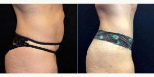 Doctor Larry Pollack, MD, San Diego Plastic Surgeon - 47 Year Old Woman Treated With Tummy Tuck