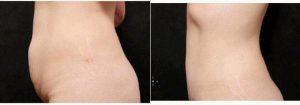 Doctor Laurie A. Casas, MD, FACS, Chicago Plastic Surgeon - 36 Year Old Woman Treated With Tummy Tuck