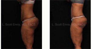 Doctor Lawrence Scott Ennis, MD, FACS, Pensacola Plastic Surgeon - 34 Year Old Female With Abdominoplasty And Liposuction Of The Lateral Abdomen