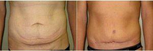 Doctor Lyle M. Back, MD, Cherry Hill Plastic Surgeon - 65 Year Old Woman Treated With Tummy Tuck