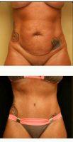 Doctor Mark Eberbach, MD, Tampa Plastic Surgeon - Abdominoplasty With Lipo Of Abdomen, Flanks And Low Back