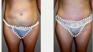 Doctor Michael Zenn, MD, Cary Plastic Surgeon - 41 Year Old Woman Treated With Tummy Tuck