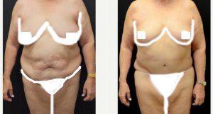 Doctor Mokhtar Asaadi, MD, West Orange Plastic Surgeon - 61 Year Old Woman Treated With Tummy Tuck