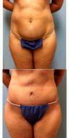 Doctor Paul S. Gill, MD, Houston Plastic Surgeon - 63 Year Old Woman Treated With Tummy Tuck With Lipo To Flanks