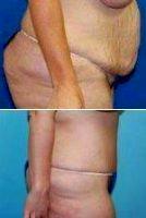 Doctor Paul S. Gill, MD, Houston Plastic Surgeon - Extensive Liposuction With Tummy Tuck