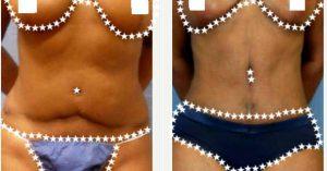 Doctor Raj S. Ambay, MD, Tampa Plastic Surgeon - 46 Year Old Woman Treated With Tummy Tuck