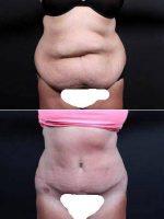 Doctor Remus Repta, MD, Scottsdale Plastic Surgeon - This Patient Underwent A Full Tummy Tuck With Liposuction