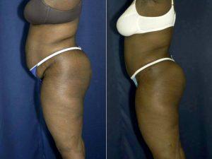 Doctor Ricardo L. Rodriguez, MD, Baltimore Plastic Surgeon - Abdominoplasty And Liposuction To Flanks