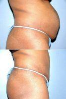 Doctor Richard Kofkoff, MD, FACS, Saint Louis Plastic Surgeon - Abdominoplasty With Power-assisted Liposuction 391