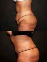 Doctor Ronald Downs, MD, FACS, South Bend Plastic Surgeon - 38 Year Old Woman Tummy Tuck, Medial Thighplasty And Liposuction Flanks