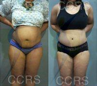 Doctor Sameer Karkhanis, MS, DNB, India Plastic Surgeon - 32 Yr. Old Female. Tummy Tuck With VASER Lipo For Body Contouring