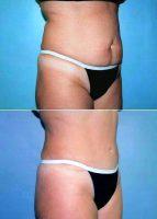 Doctor William F. DeLuca Jr, MD, Albany Plastic Surgeon - Tummy Tuck With Liposuction
